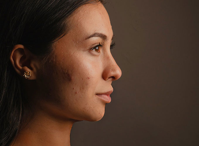 Seitliches Porträt einer Person mit dunkler Haut, leichter Akne und langem Haar, die ein rundes, goldfarbenes Ohrstecker trägt